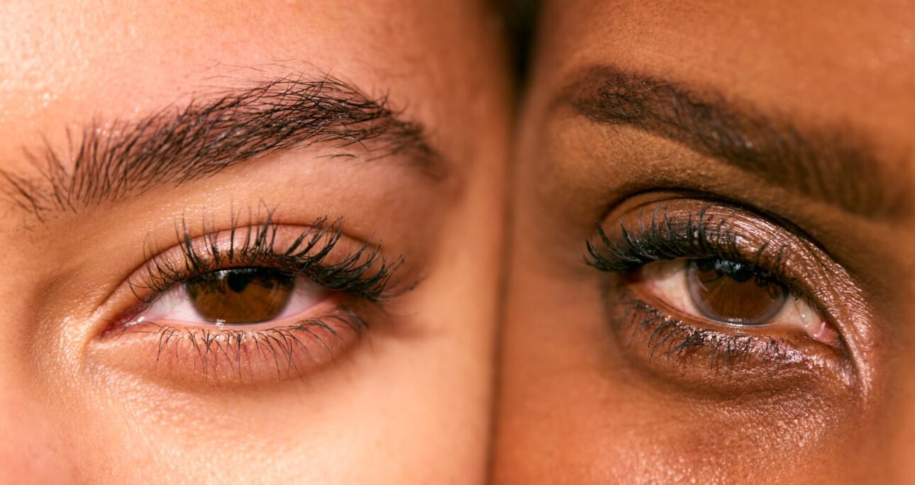 Is Fox Eye Surgery Right for You?