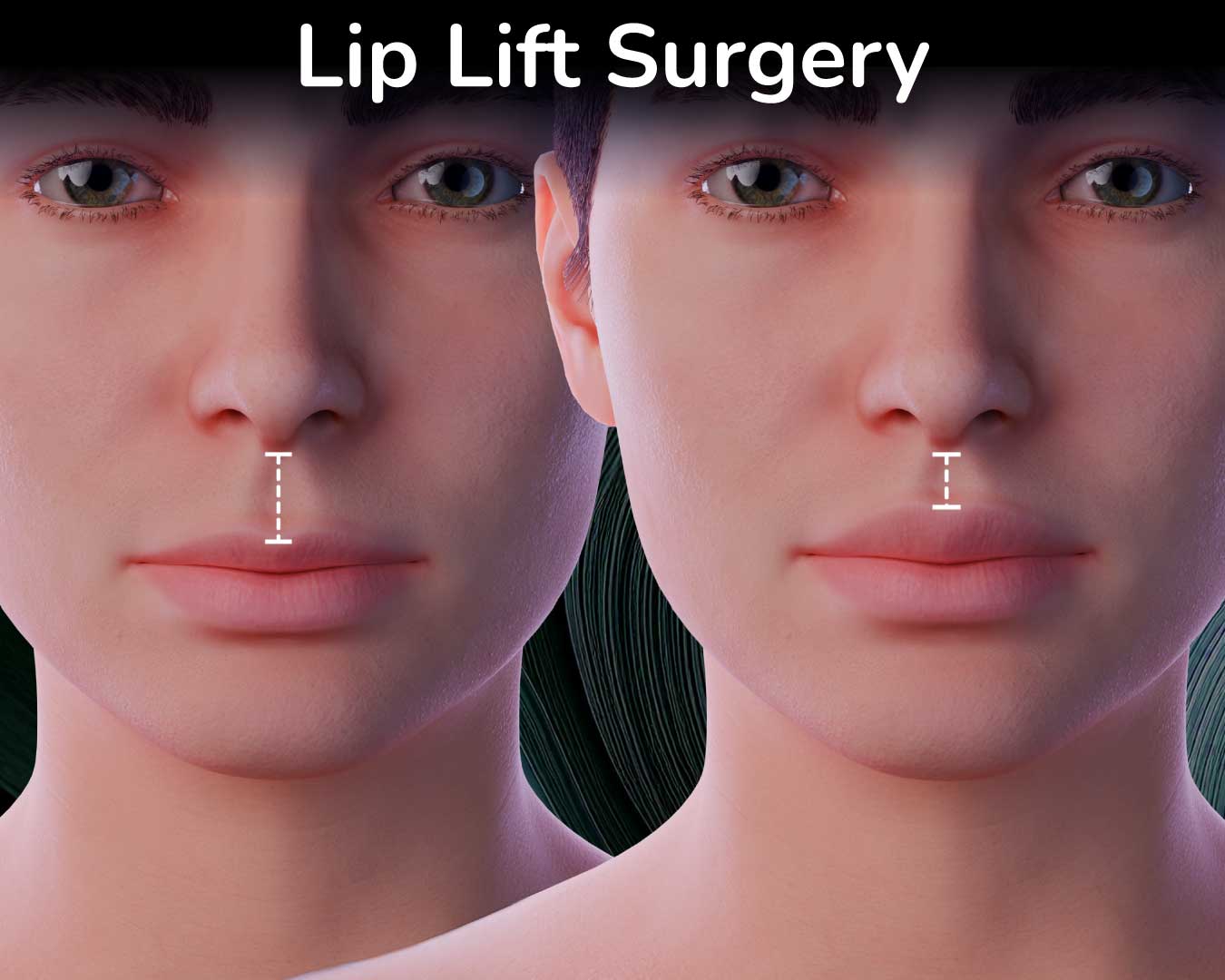 Lip Lift Procedure in FFS