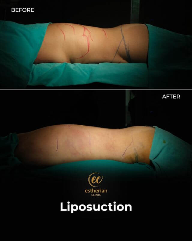 Liposuction before and after