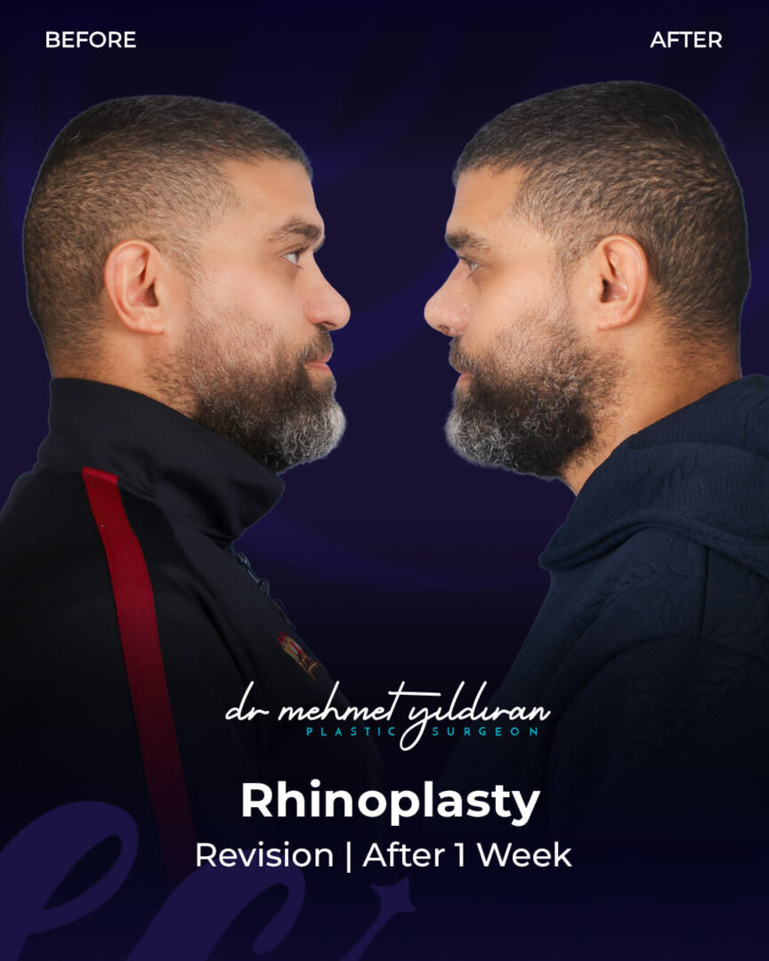 Male Ethnic Rhinoplasty for a Middle-eastern Nose by Dr. Mehmet Yildiran