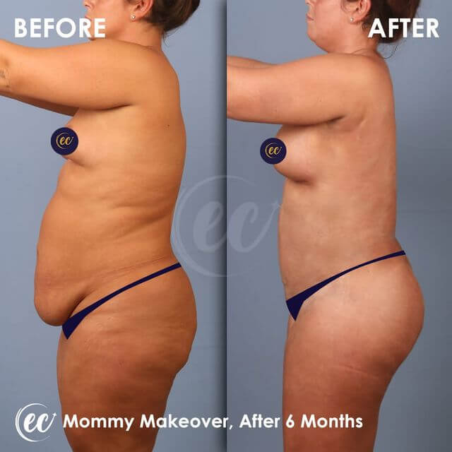 Mommy Makeover after 6 months (before and after)