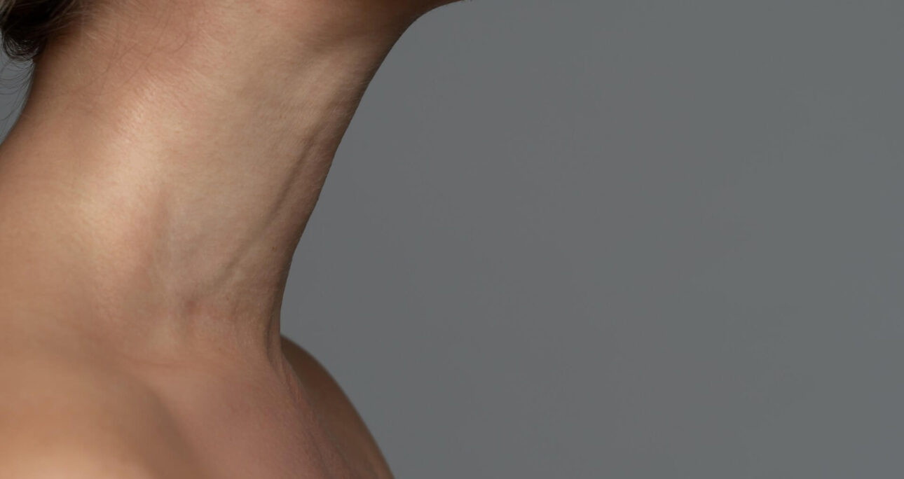 Neck Liposuction Before and After