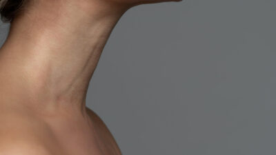 Neck Liposuction Before and After
