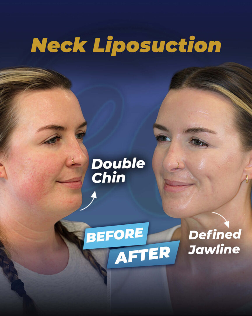 Neck liposuction before and after
