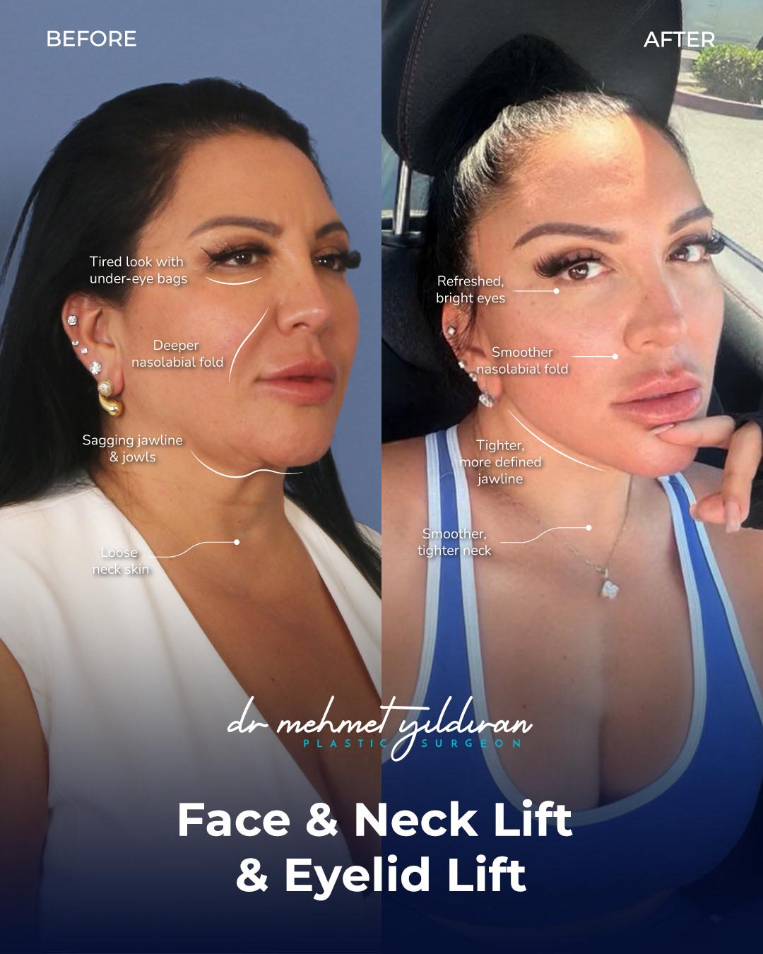 Real Patient Success Story - Face and Necklift and Eyelid LIFT.jpg