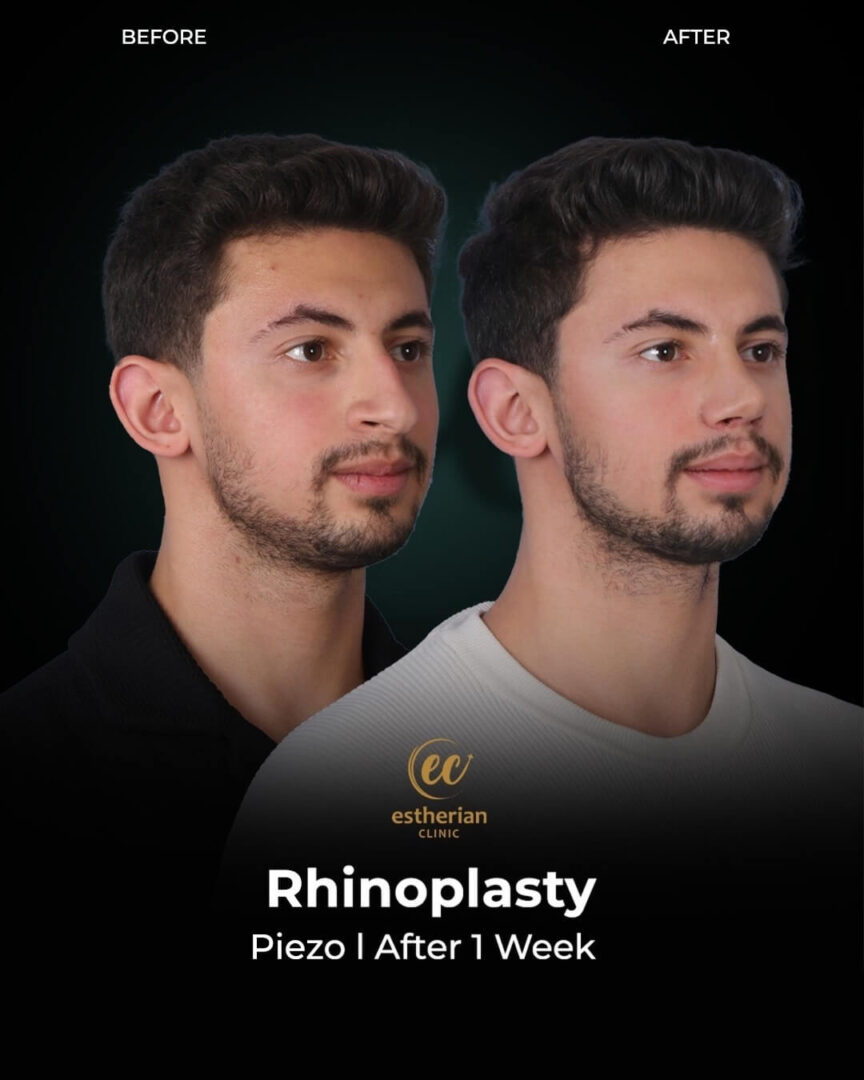 Rhinoplasty 1-week Post-op Real Results