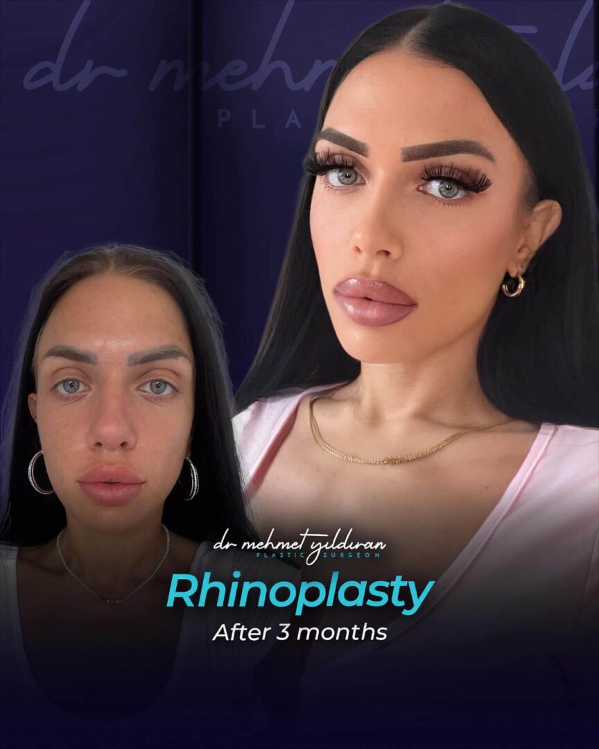 Rhinoplasty (A part of Facial Feminization Surgery) results by Dr. Mehmet Yildiran (real patient before-and-after)