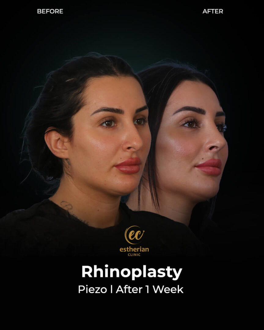 Rhinoplasty Results After 1 Week