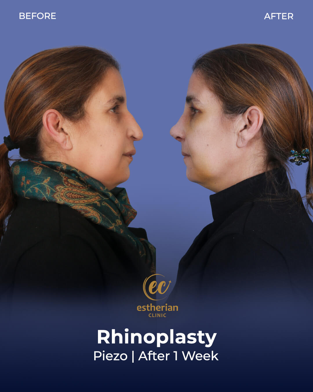 Rhinoplasty Results (Real Patient) 