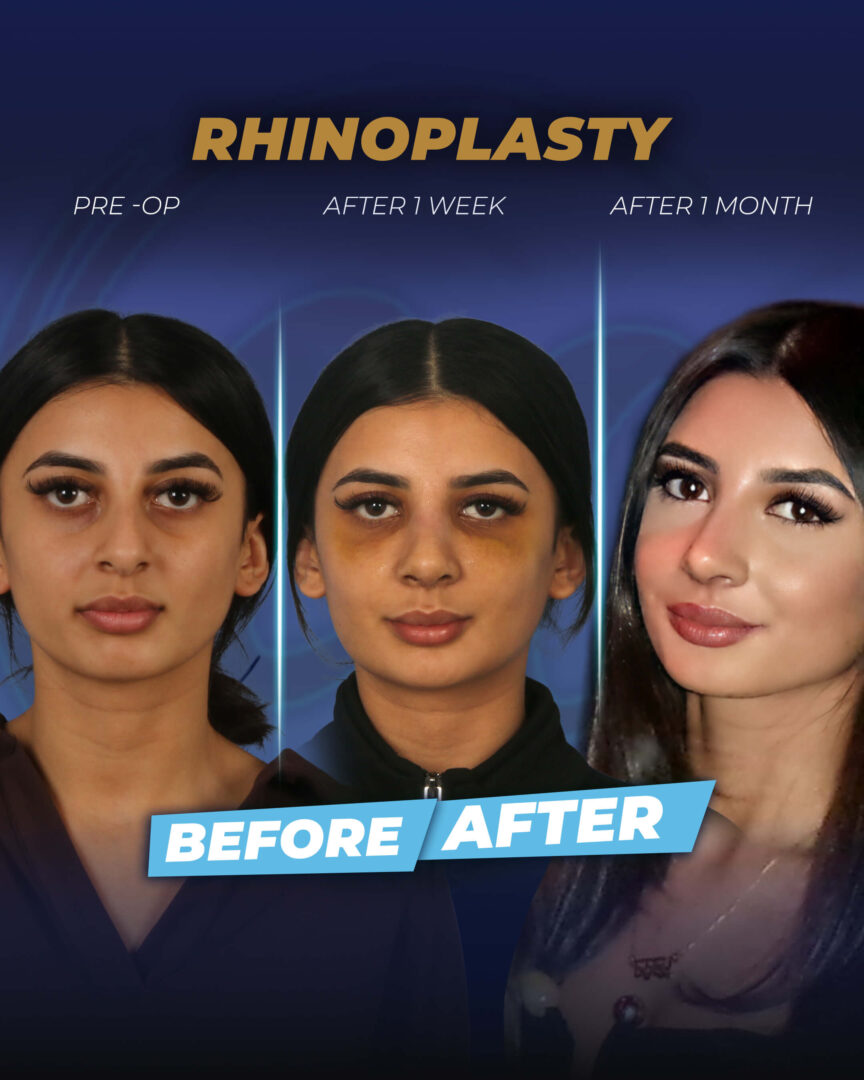 Rhinoplasty before and after ( real patient success story)