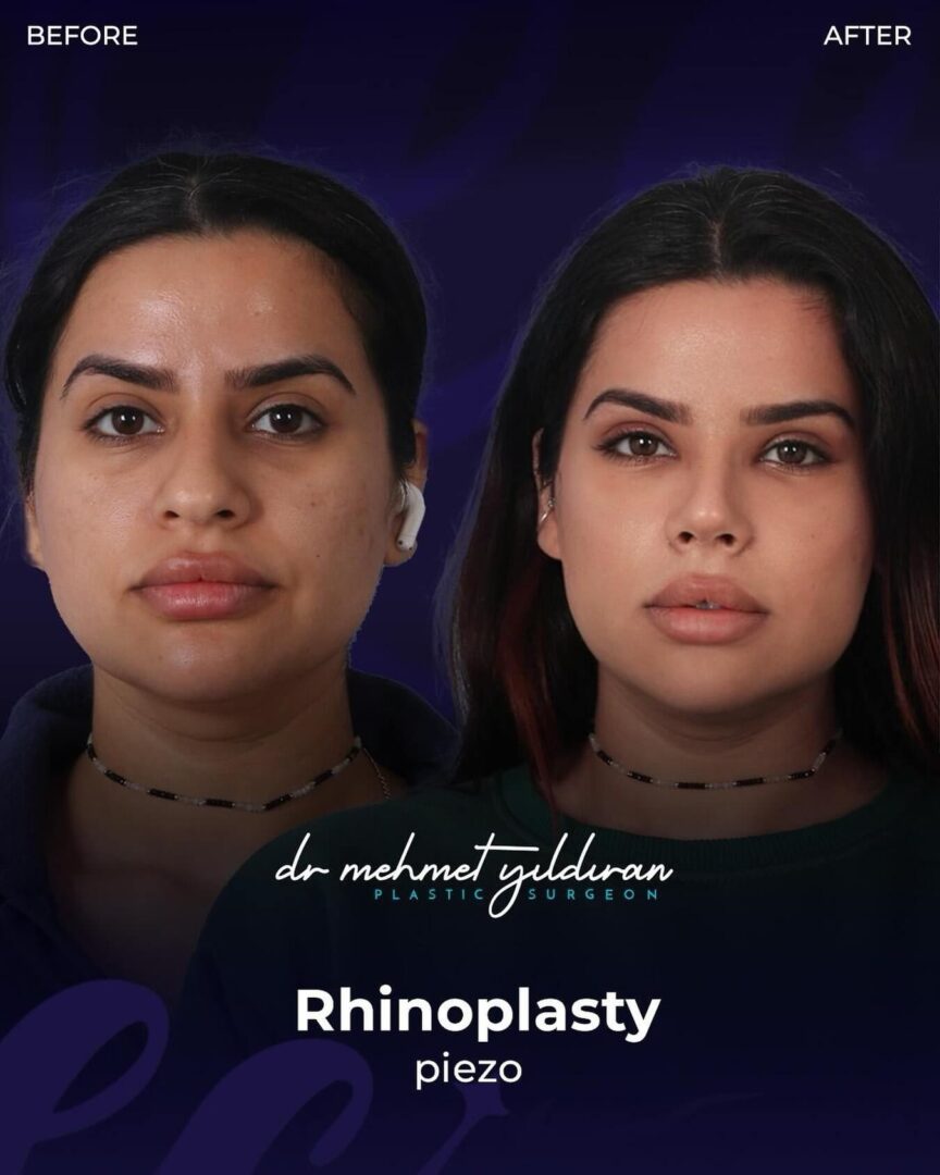 Rhinoplasty (feminizing the nose)  Before-and-after transformation by Dr. Mehmet Yildiran