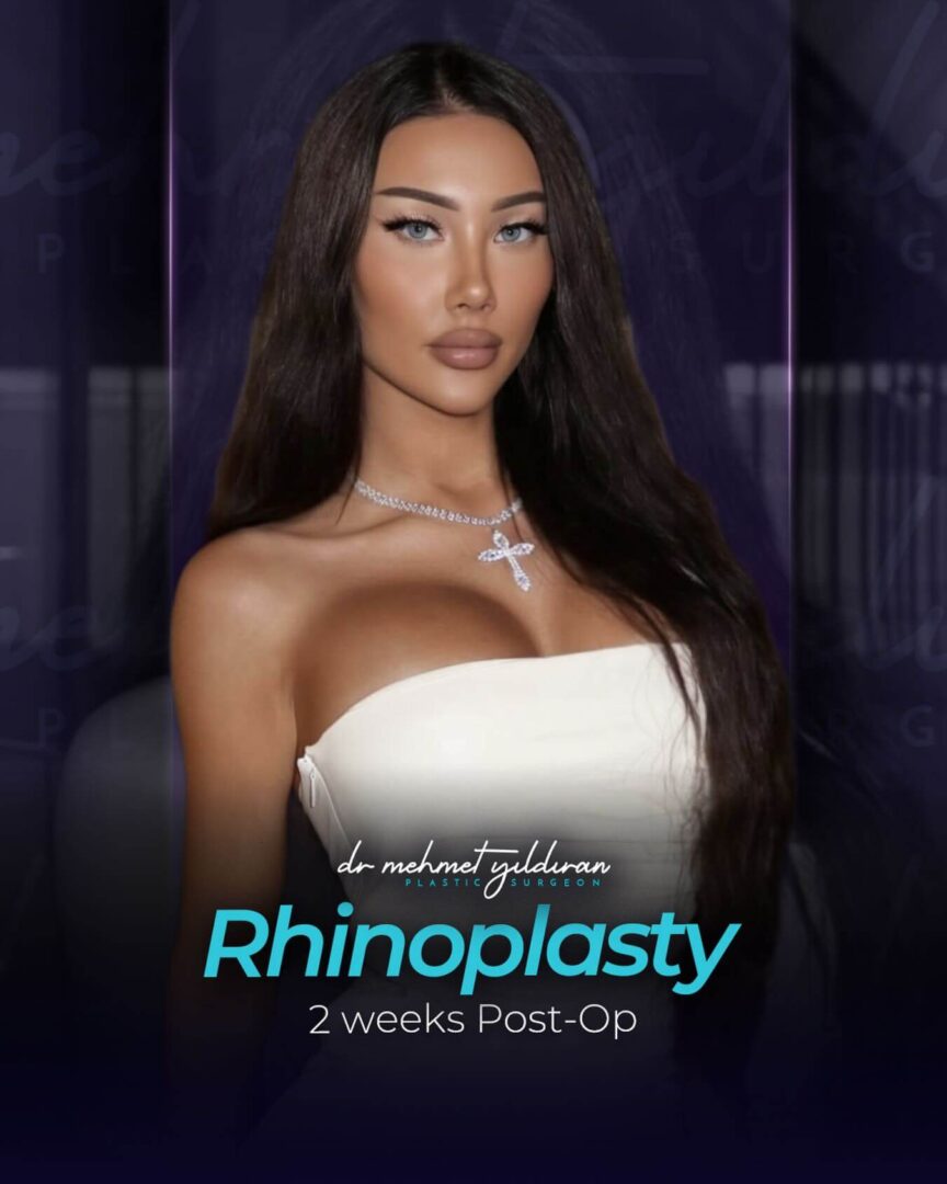 Rhinoplasty results 2-weeks post-op (By Dr. Mehmet Yildiran)