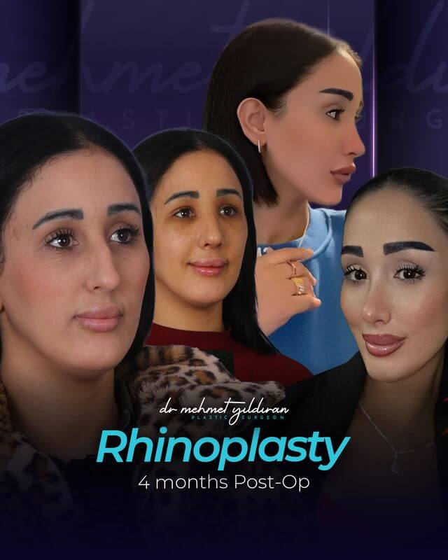 Rhinoplasty results 4-months post-op by Dr. Mehmet Yildiran