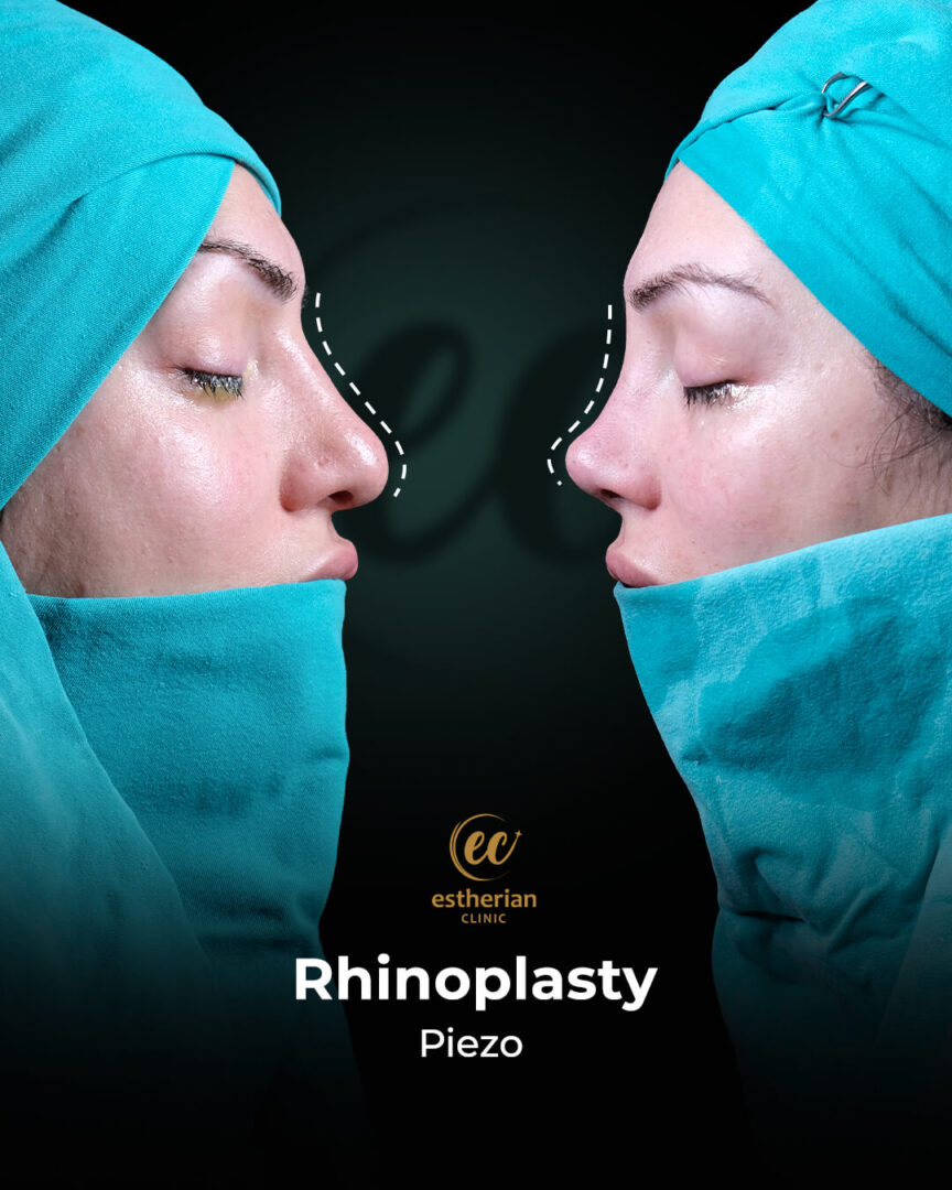 Rhinoplasty results (Real Patient Transformation)