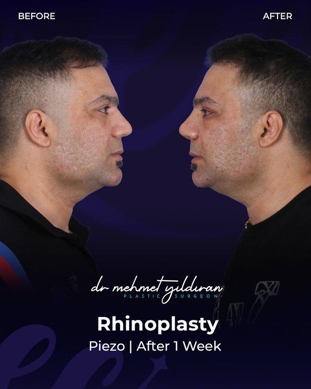 Rhinoplasty results after 1 week by Dr. Mehmet Yildiran