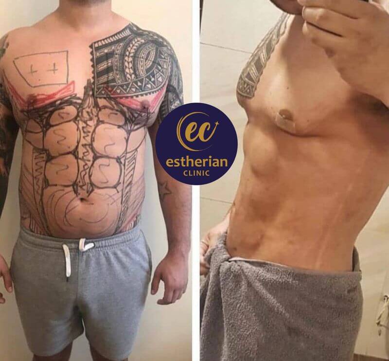 Six-pack abs surgery before and after by the Estherian clinic (results)