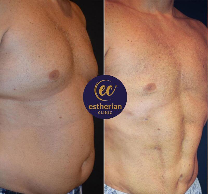 Six-pack abs surgery before and after (results)