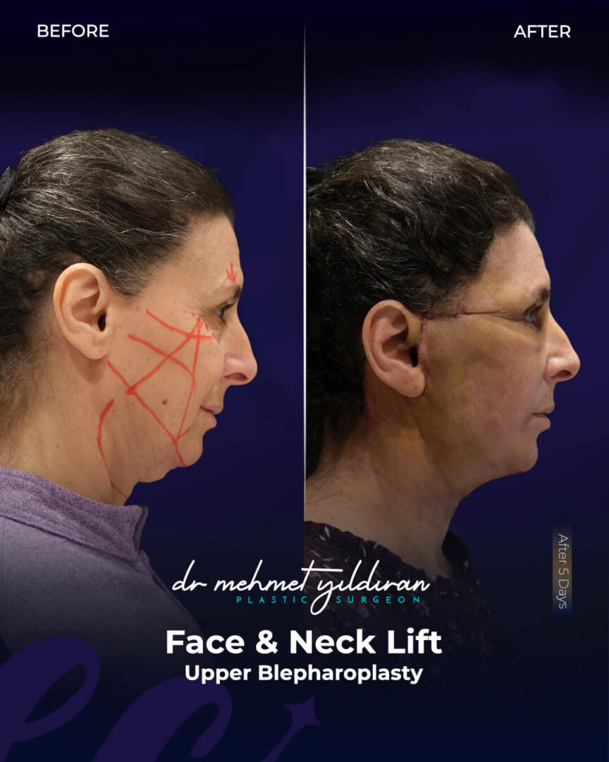 Upper Blepharoplasty, Face and Neck Lift Real Patient Before and After Transformation by Dr. Mehmet Yildiran