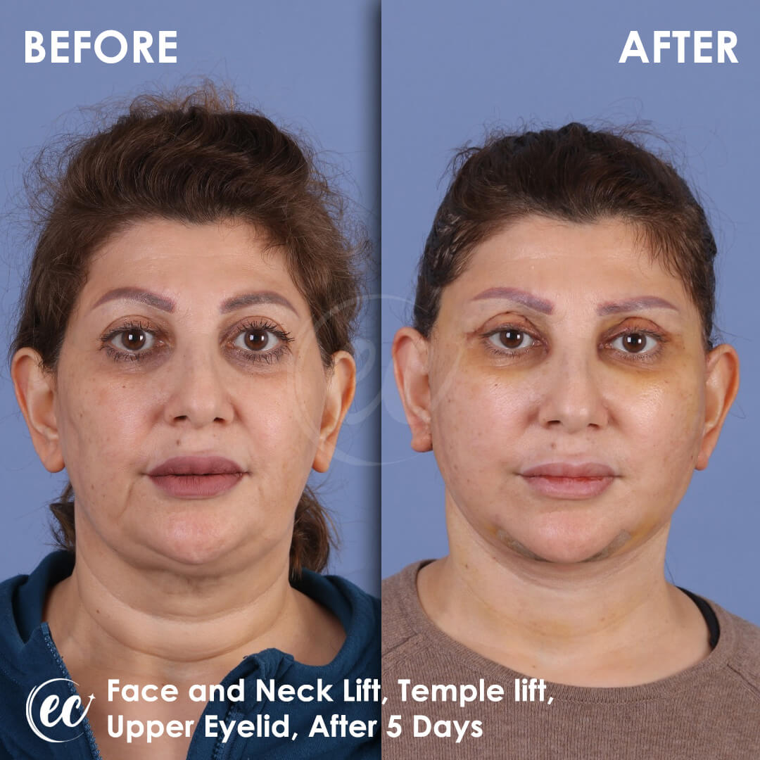Upper Blepharoplasty, Face and Neck Lift and Temple Lift before and after by Dr. Mehmet Yildiran