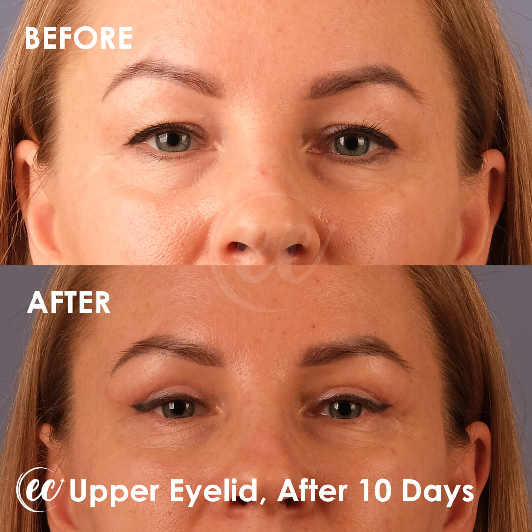 Upper Blepharoplasty Surgery Results 10 Days Post-op by Dr. Mehmet Yildiran