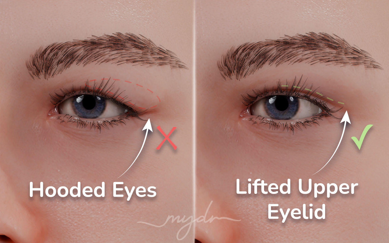 Upper-Eyelid-Surgery-Before-After