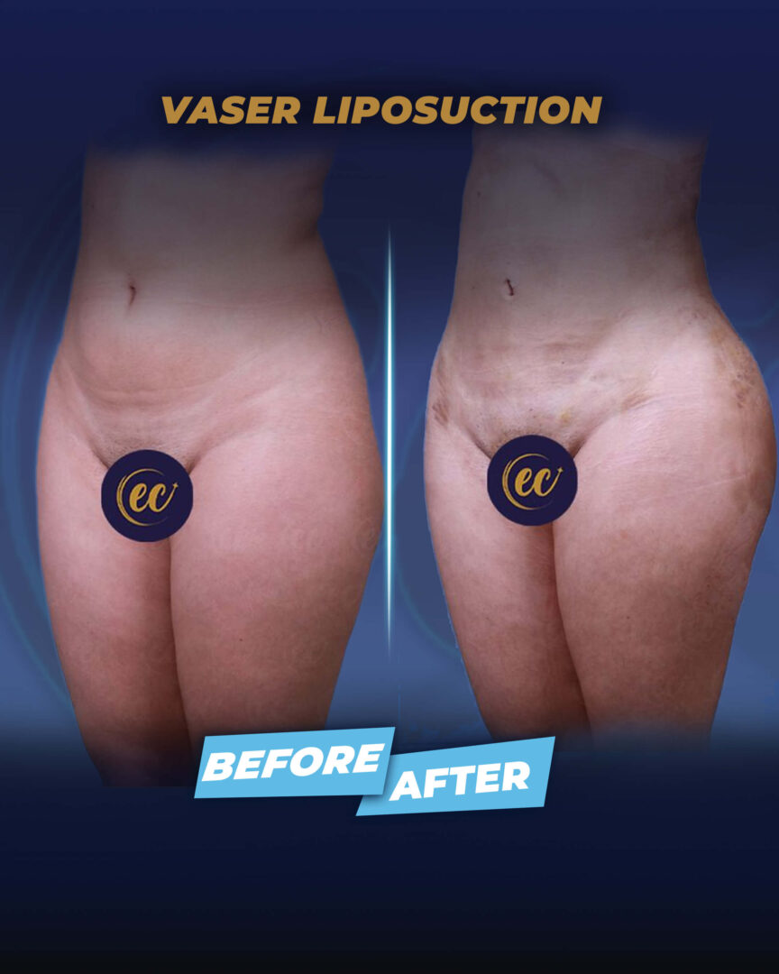Vaser Liposuction (before and after) by Dr. Mehmet.