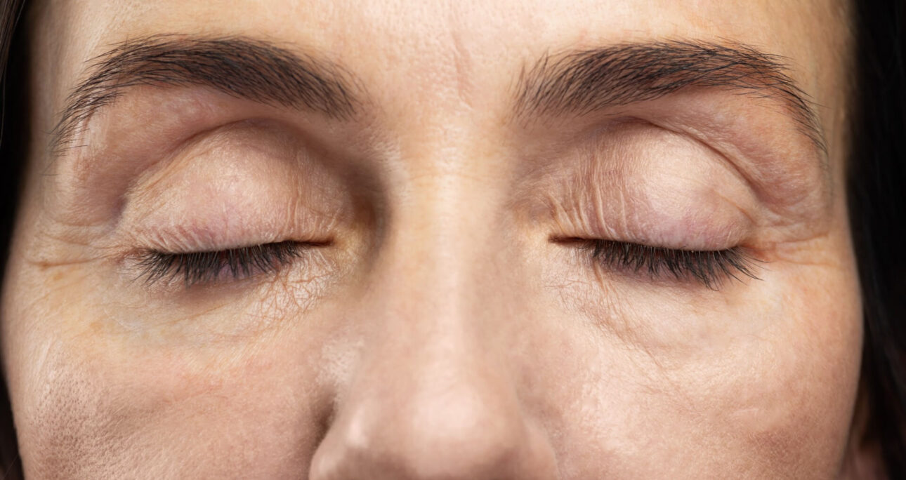 Eyelid Lift Without Surgery: Guide to Eye Rejuvenation