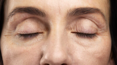 Eyelid Lift Without Surgery: Guide to Eye Rejuvenation
