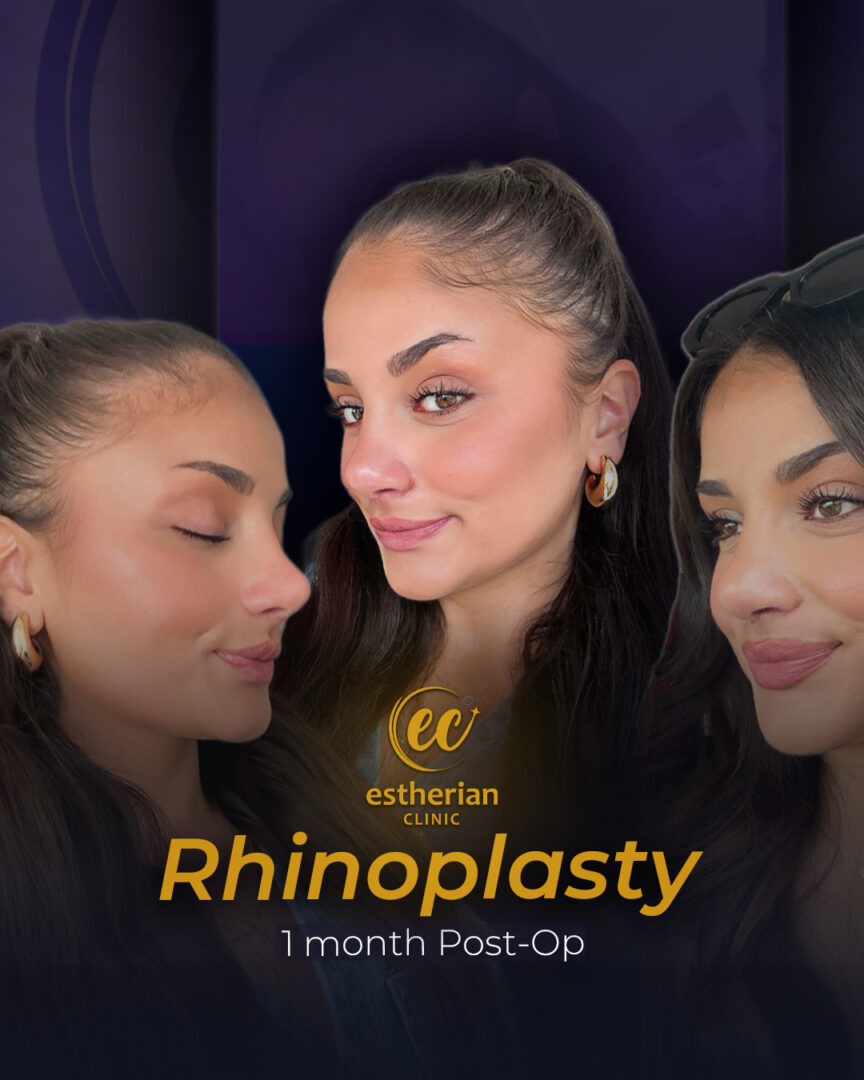 Patient Success Story: 1 month post-op Rhinoplasty
